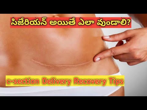 c-section delivery recovery time/c-section delivery caring tips Telugu/సిజేరియన్ అయితే ఎలా వుండాలి