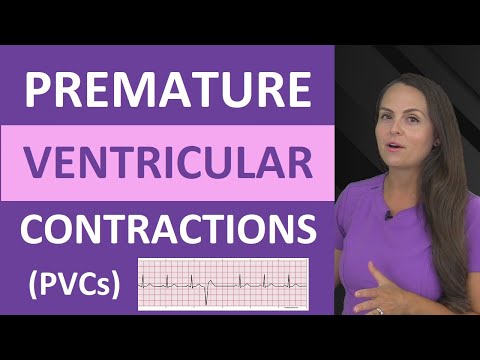 Premature Ventricular Contractions (PVCs) ECG Nursing NCLEX Bigeminy, Trigeminy
