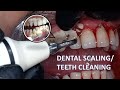 HOW IS TEETH CLEANING DONE BY DENTIST|ORAL HEALTH MAINTAINENCE 2021|LIVE STEP BY STEP