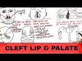 Cleft Lip And Palate Pathophysiology Causes Management