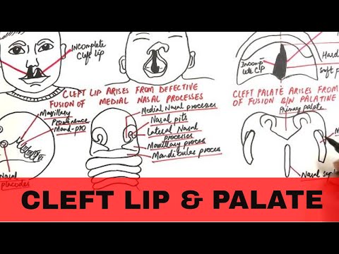Cleft Lip and Palate - Pathophysiology, Causes & Management
