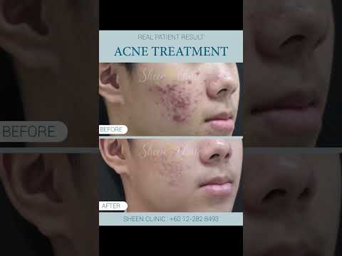 Pico Laser for Active Acne & Marks | Clear & Smooth Skin