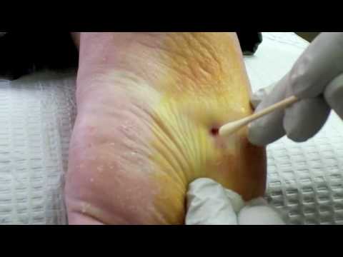 Wart treatment for