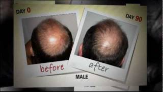 preview picture of video 'Hair Restoration NYC - 877-217-8707 - Call For Hair  Loss Help'