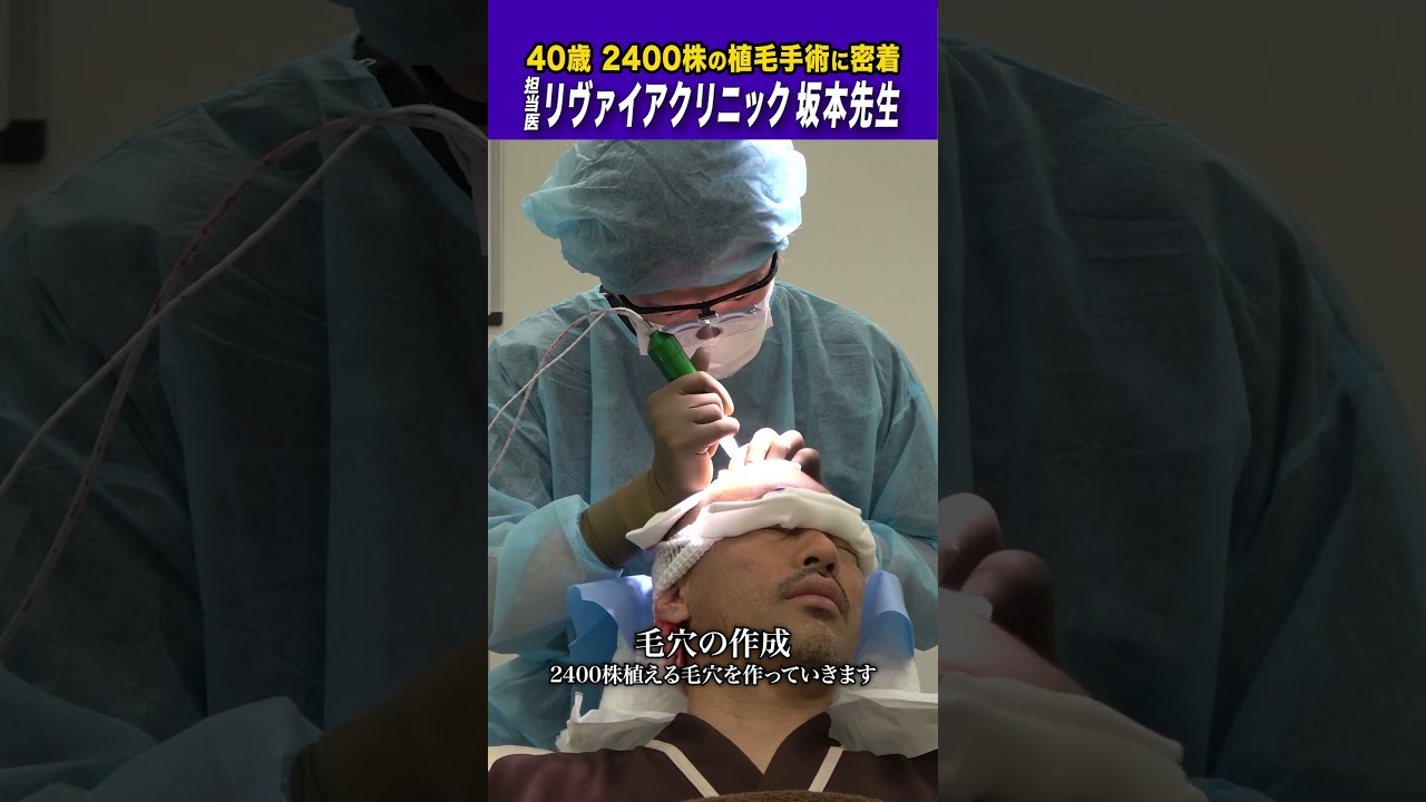 【自毛植毛のリアル】植毛手術に密着!!