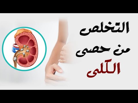 التخلص من حصى الكلى : تعرف على 7 وصفات منزلية للعلاج