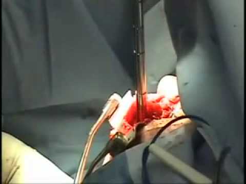 Shoulder Arthroplasty