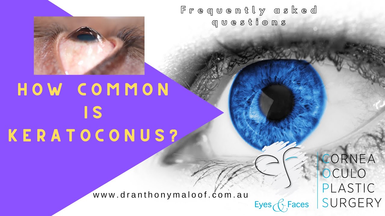 FAQ - How common is Keratoconus? - Dr Anthony Maloof, Sydney Australia