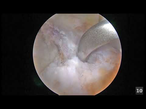 Drogen Osteochondrose der Halswirbelsäule Behandlung Reflex Syndrome der Osteochondrose
