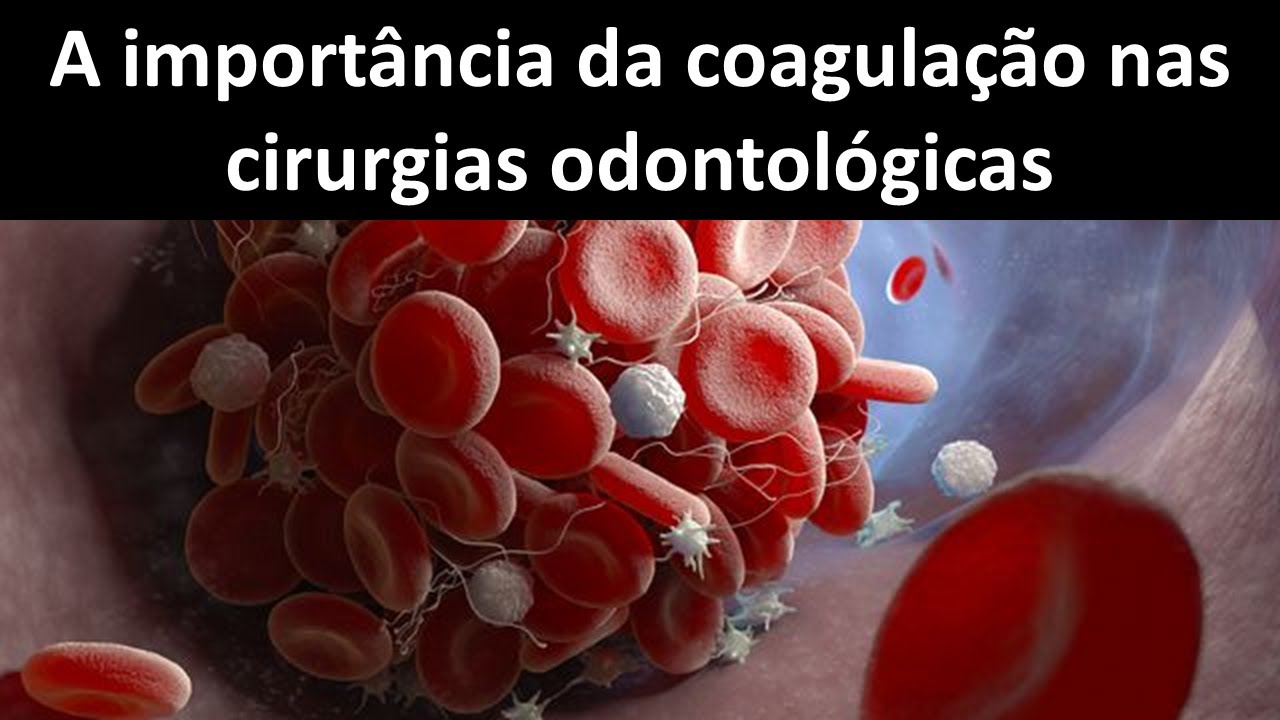 A importancia da coagulação nas cirurgias odontológicas | Odontologia | Dra Bianca Rosa