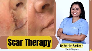 Scar therapy- make your scars disappear (almost!)  -By Dr. Amrika Seshadri #scartherapy