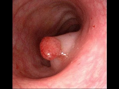 Prostatitis, wenn aureus Die Öle sind nützlich für die Prostata