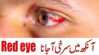 subconjunctival hemorrhage|red spot in eye