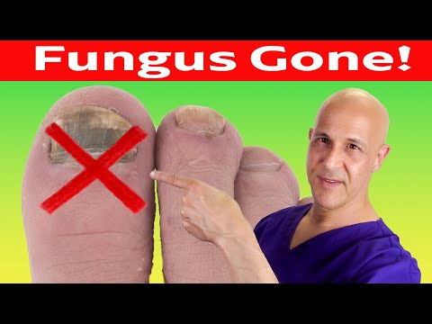 Toe Nail Fungus Cured With Simple Home Remedy (No Medication)  Dr. Mandell
