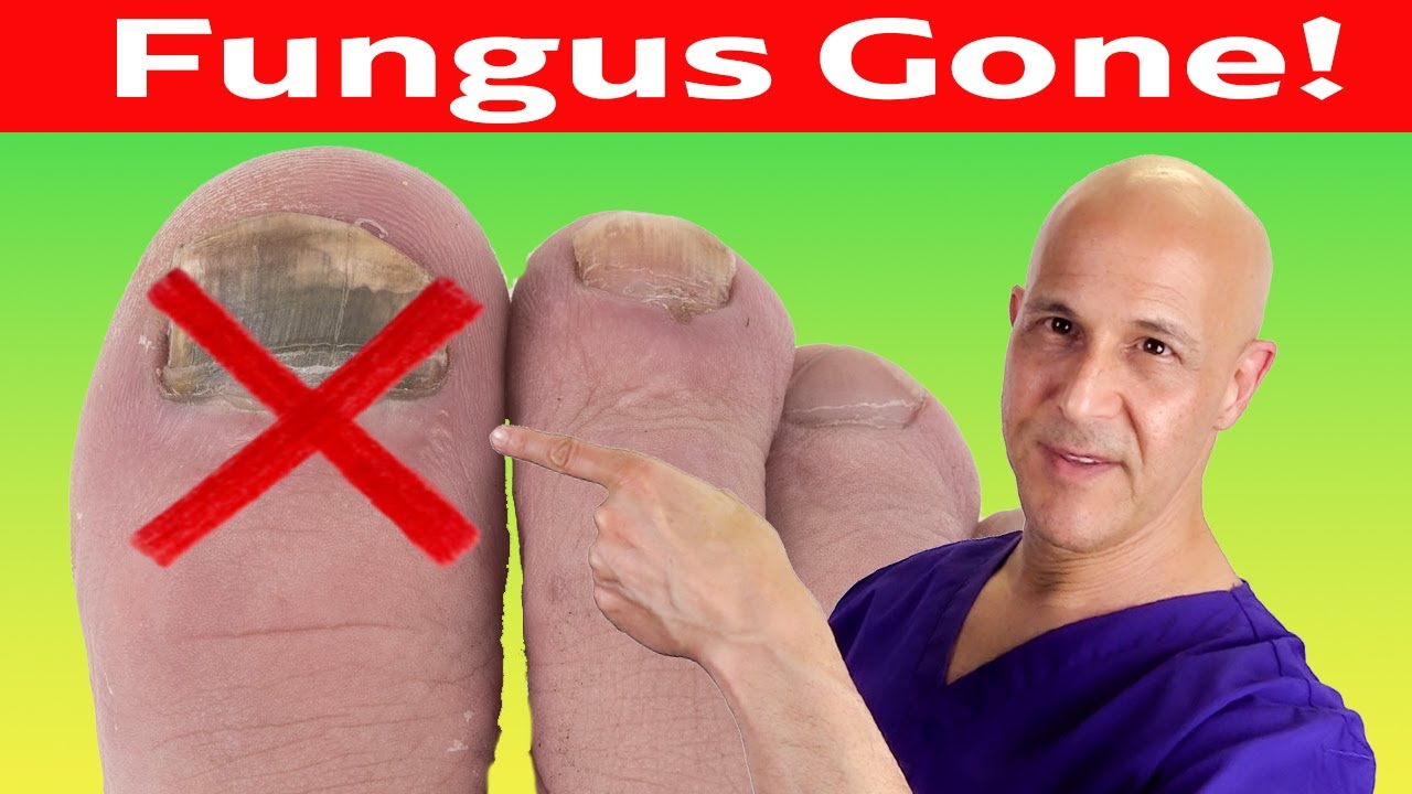 Toe Nail Fungus Cured With Simple Home Remedy (No Medication)  Dr. Mandell
