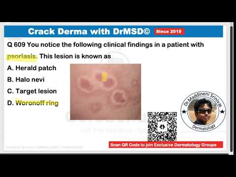 609 Woronoff ring Psoriasis | #crackdermawithdrmsd 609