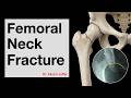 Femoral neck fracture - applied anatomy