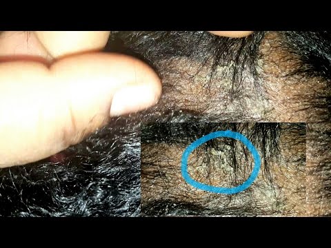 Kung paano gumawa ng pamahid para sa kuko halamang-singaw Pamahid at tablets mula sa fungi sa isang paa