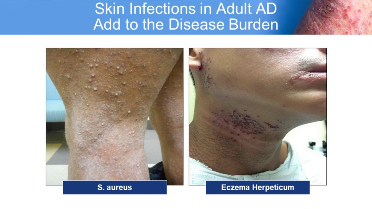 Atopic Dermatitis: Strategies to Improve Outcomes (Adult: Moderate-Severe)