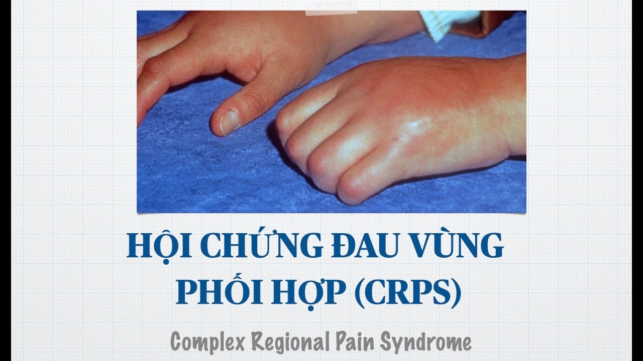 Hội Chứng Đau Vùng Phức Tạp CRPS