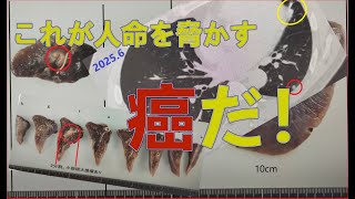 【大腸がんステージⅣ多発肝転移】肺転移切除腫瘍公開！2カ月の進行の速さがヤヴァイ！？【現在闘病中㉖】