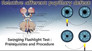 Pupil 3 | How to Perform the Swinging Flashlight Test