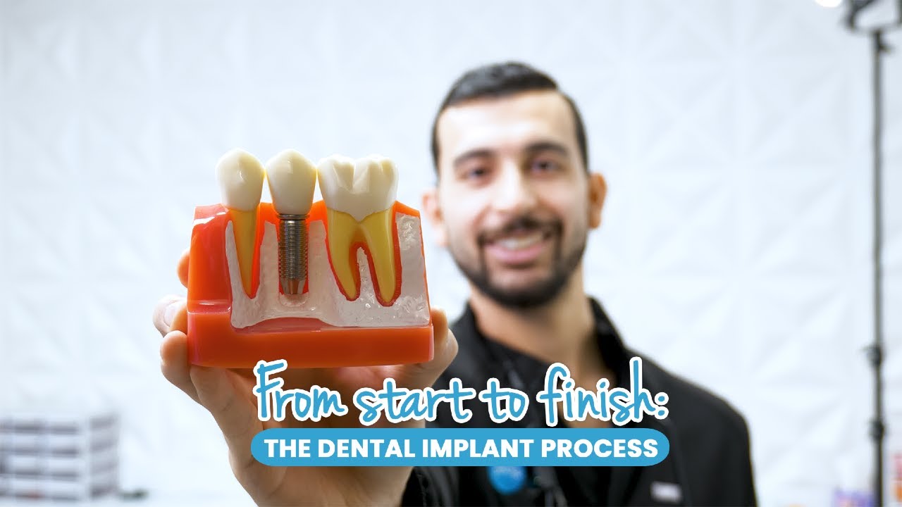 Dental Implants Explained — Smile Avenue Family Dentistry
