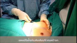 เสริมหน้าอกด้วยไขมันตัวเอง เสริมหน้าอกด้วยไขมันตัวเอง