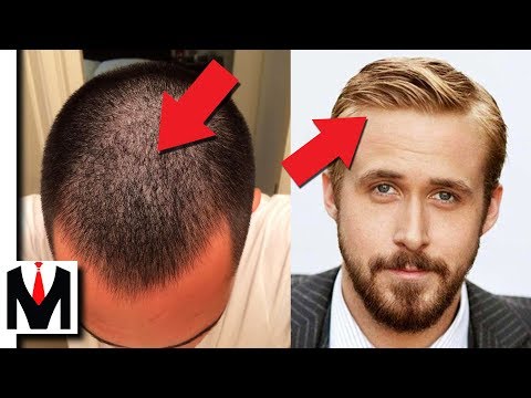 YouTube video about: Can see my scalp under direct light?