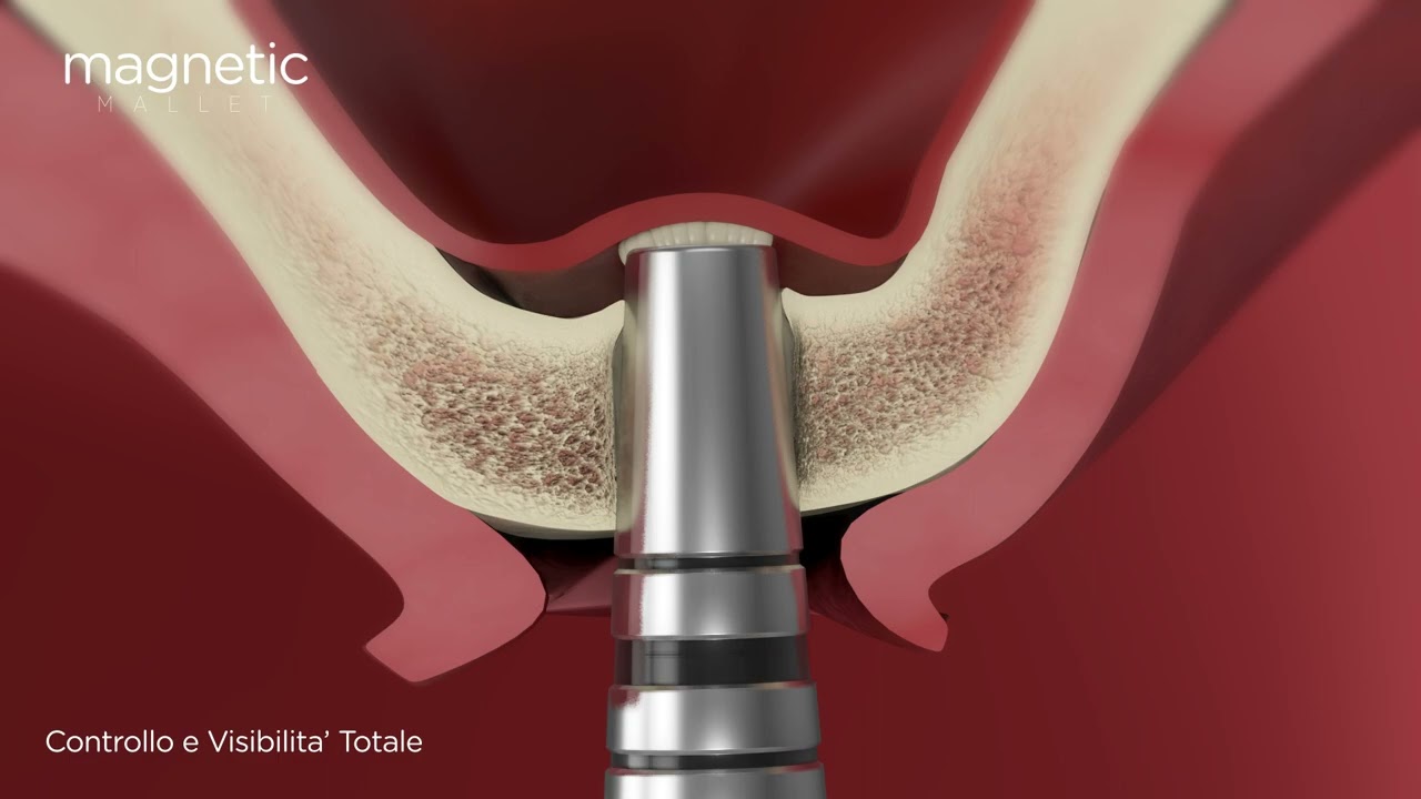 Kit Osteotomi Silver — demonstration video (OSSEOTOUCH)