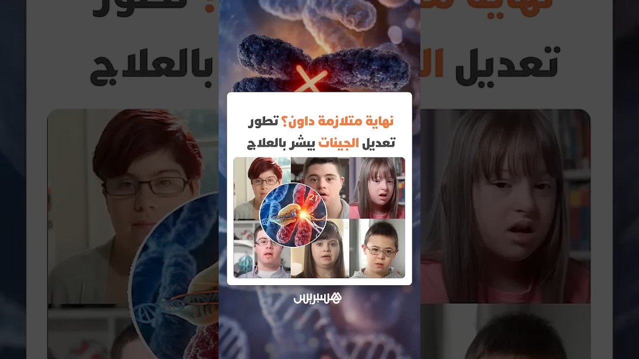 اختراق علمي يفتح الباب أمام إمكانية تعطيل كروموسوم زائد   بصيص أمل لعلاج متلازمة داون عبر تعديل thumbnail