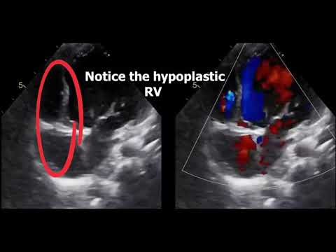 Single ventricle echo-morphology "Part 1 "