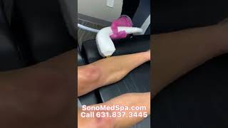 Laser Hair Removal with Venus velocity