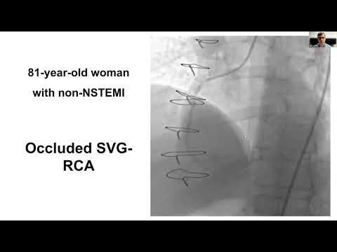 Mastering CTO Revascularization in 2025 – Insights by Dr. Emmanouil S. Brilakis