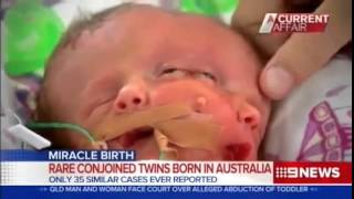 Miracle conjoined twins die shy of three weeks | Baby with two faces dies