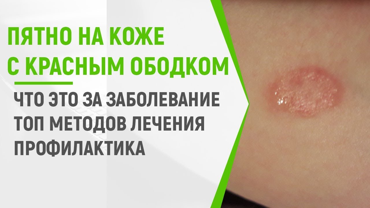 Пятно на коже с красным ободком