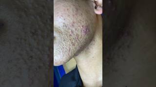 Full video in the comment section #sacdepspa #acne