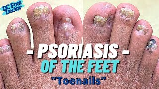 Psoriasis and the Feet: Part 1, Trimming Psoriatic Nails