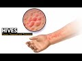 HIVES Causes Signs And Symptoms Diagnosis And Treatment