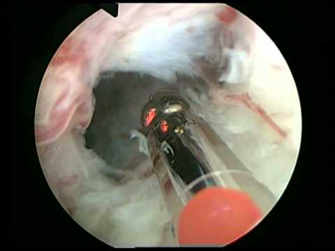 GreenLight Enucleation of the Prostate