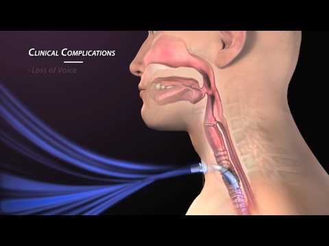 Clinical Complications of Tracheostomy