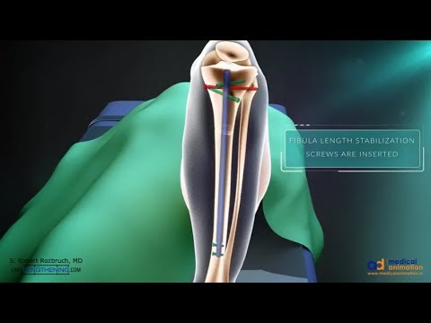 Precice Tibia Lengthening Surgical Animation