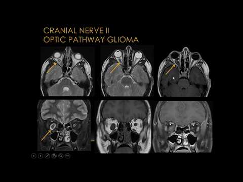 Cranial Nerves MRI Diagnostics - Part 1 - [Basic Radiology]