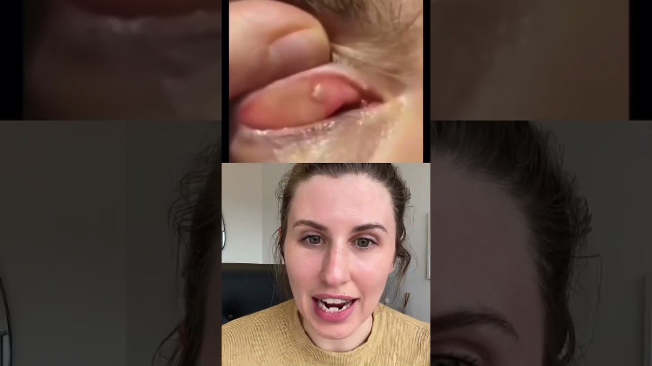 Can you get a whitehead on the inside of your eyelid? Tipseri