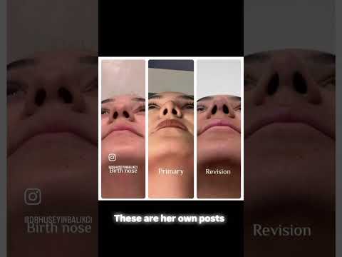 Natural Revision Rhinoplasty in Antalya, Turkey | Assoc. Prof. Dr. Hüseyin Balıkçı