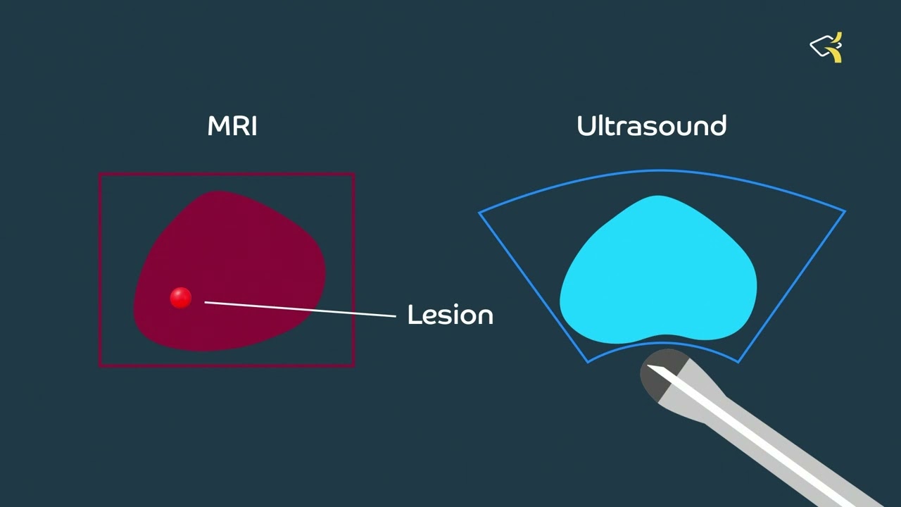 Cognitive versus fusion biopsy