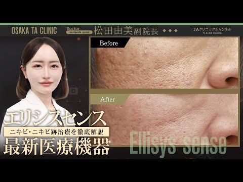 【2026年最新版】ニキビ・ニキビ跡治療を徹底解説！ 最新医療機器！エリシスセンスとは！？
