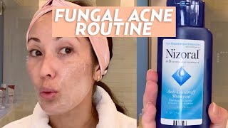 Treat Fungal Acne With This Skincare Routine | #SKINCARE