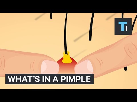 What's Really Inside a Pimple?