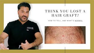 Canadian Hair Transplant Centre
